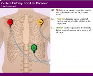 3 lead ECG placement