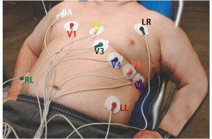 12 lead ECG placement on Fat guy guide