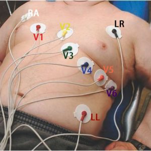 12 lead ECG placement on Fat guy guide