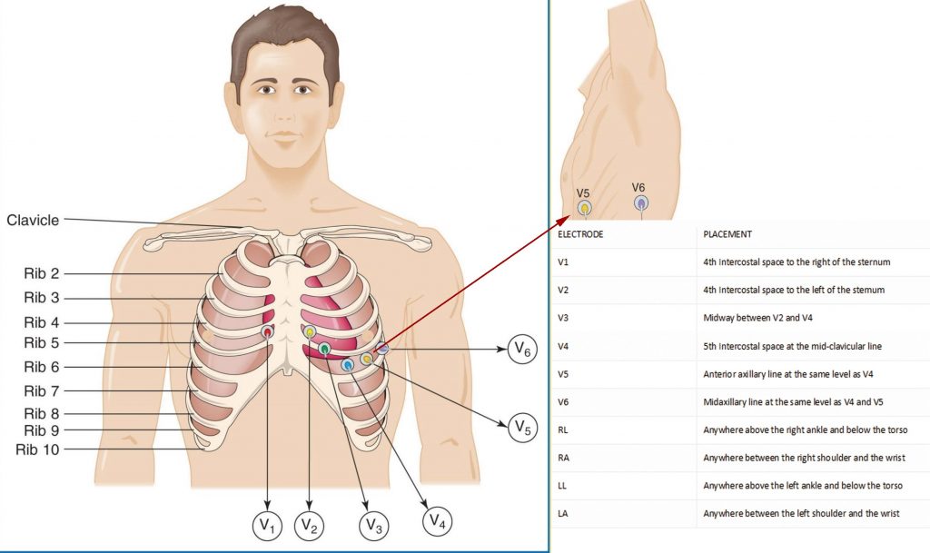 12 lead ECG replacement